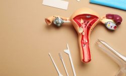 Инсулинорезистентность снижала фертильность при полиэндокринном овариальном синдроме