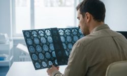 Частота развития инсульта среди людей молодого возраста в США удвоилась за 27 лет